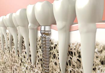 Mutuelle implant dentaire